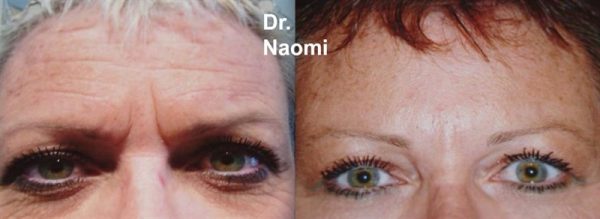 Before and after forehead shape treatment