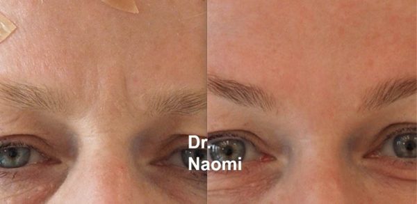 Before and after forehead shape treatment