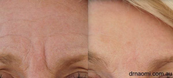 Before and after forehead shape treatment