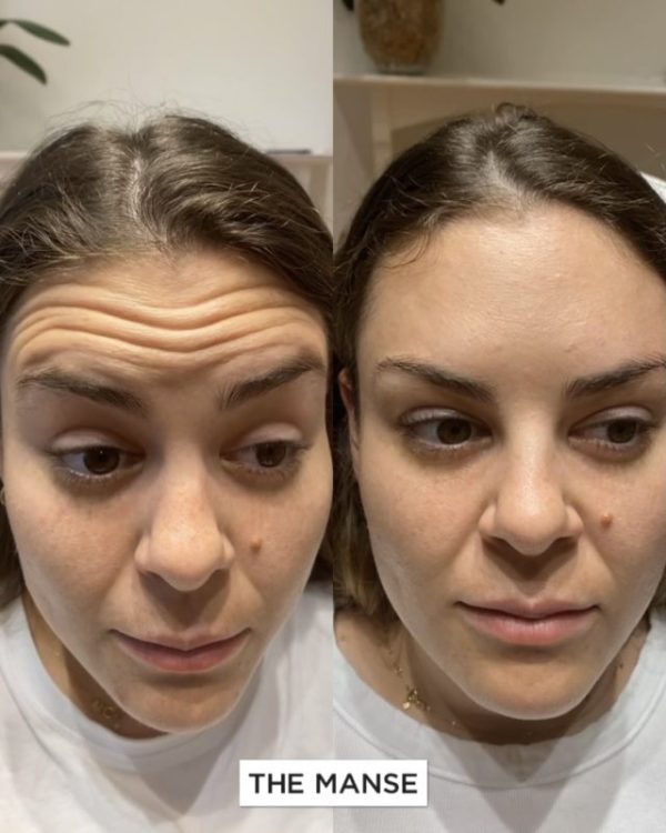 Before and after forehead treatment