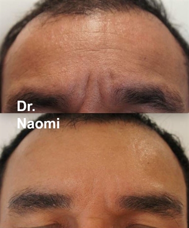 Before and after forehead treatments