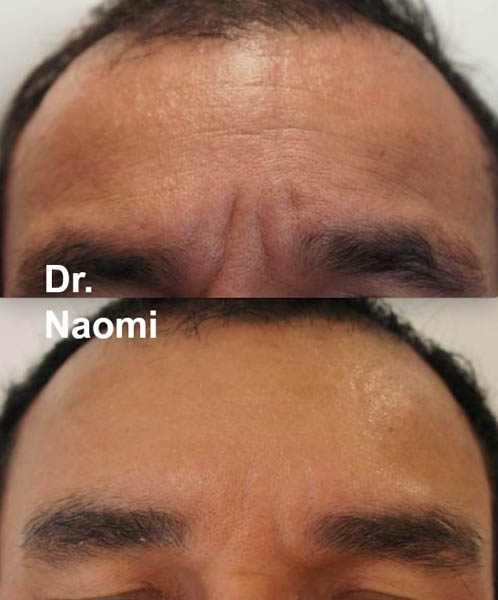 Before and after forehead treatments