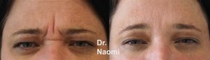 Before and after frown line treatments