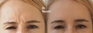 Before and after frown line treatments