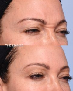Before and after frown line treatments
