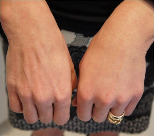 Before and after hand rejuvenation