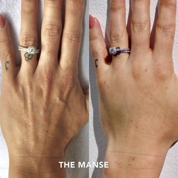 Before and after hand rejuvenation