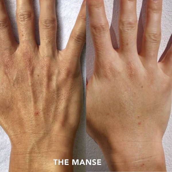 Before and after hand restoration
