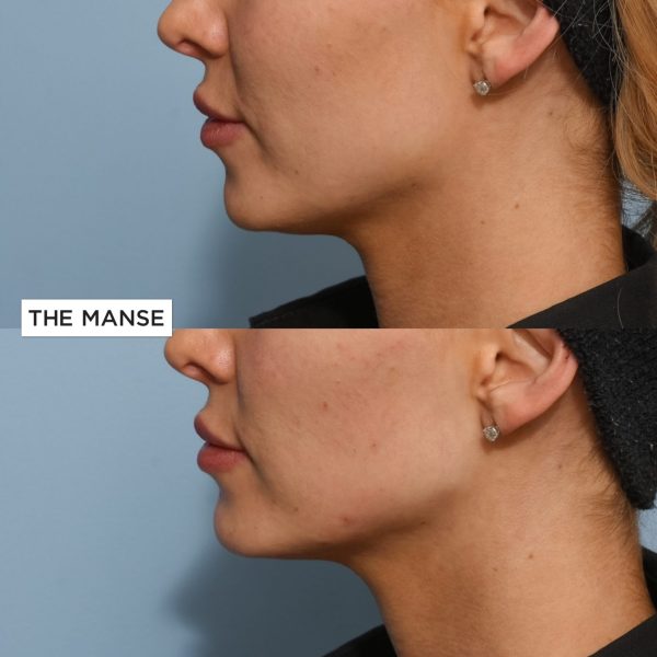 Before and after jawline and chin treatment