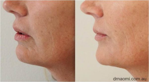 Before and after jawline improvement