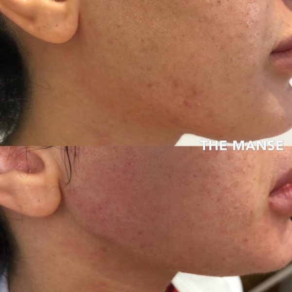 Before and after jawline reshaping