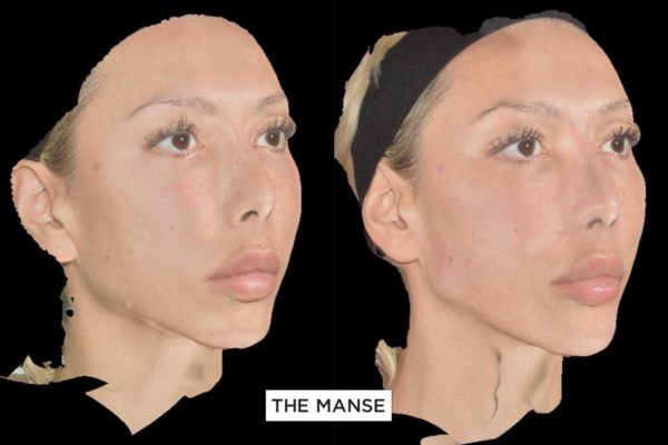 Before and after jawline reshaping