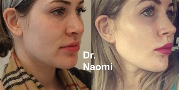 Before and after jawline reshaping