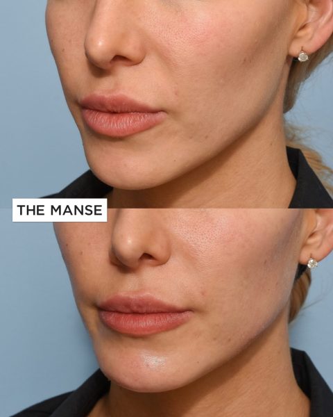 Before and after jawline treatment