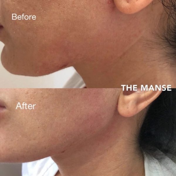 Before and after jawline treatment