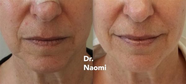 Before and after jowl treatment