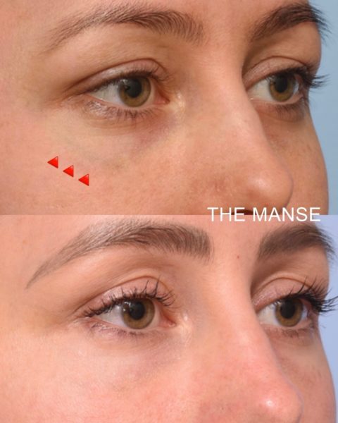 Before and after laser and other treatments for tear troughs