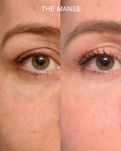 Before and after laser for dark vein and other treatments for tear troughs.