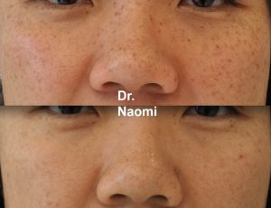Before and after laser for pigmentation removal Asian skin type