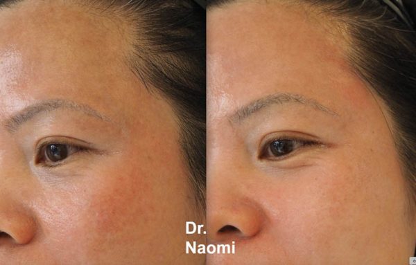 Before and after laser melasma treatment