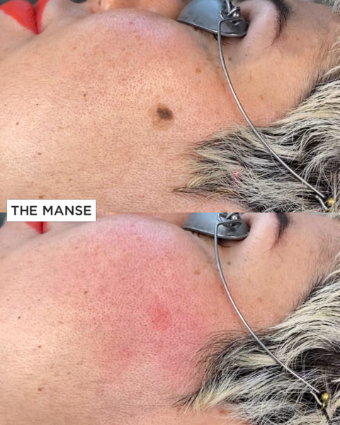 Before and after laser mole removal