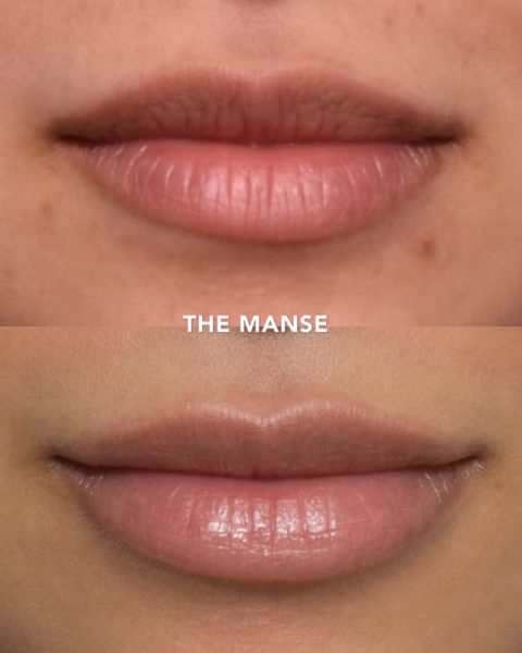 Before and after lip treatment