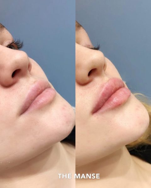 Before and after lip treatment