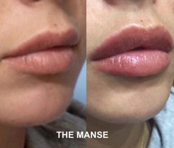 Before and after lips
