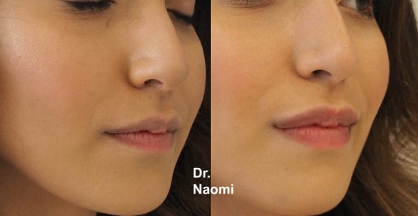 Before and after lips
