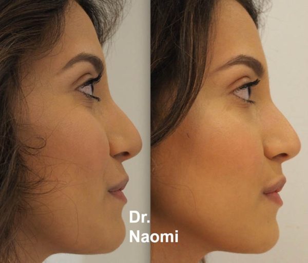 Before and after lips