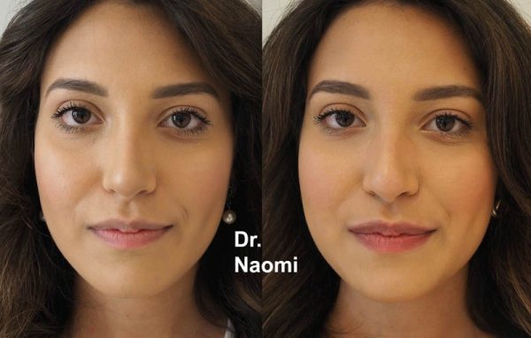 Before and after lips