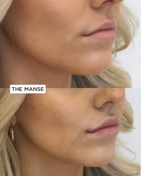 Before and after lips