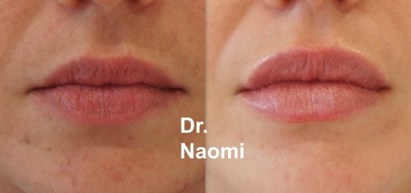 Before and after lips