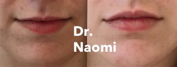 Before and after lips
