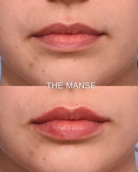 Before and after lips