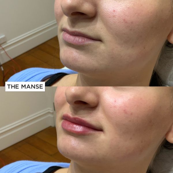 Before and after lips