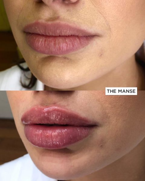 Before and after lips