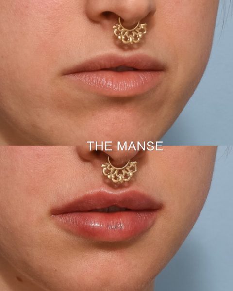 Before and after lips