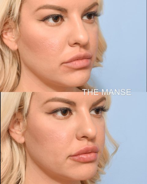 Before and after lips