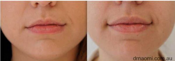 Before and after lips