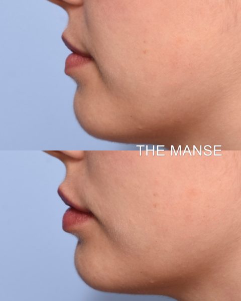 Before and after lips side view subtle results