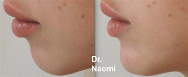 Before and after lower face reshaping