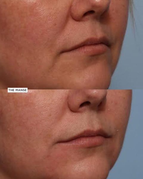 Before and after marionette fold treatment at our Sydney clinic
