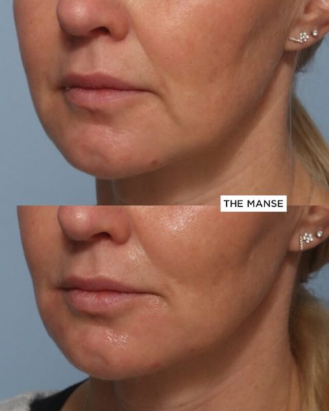 Before and after marionette fold treatment at our Sydney clinic