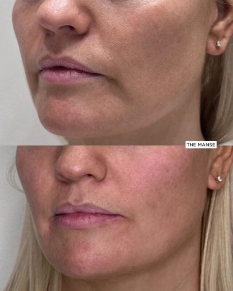 Before and after marionette fold treatment at our Sydney clinic