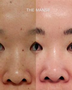 Before and after mole removal, Asian skin