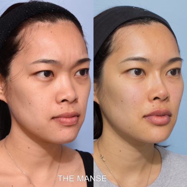 Before and after multiple treatments