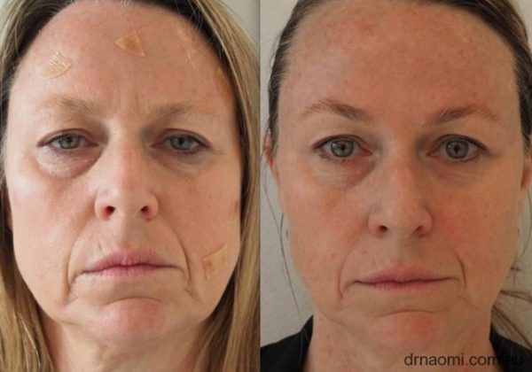Before and after multiple treatments