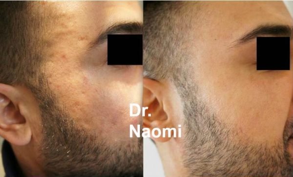 Before and after multiple treatments for acne scarring including fractional laser, lifting treatments and skinbooster