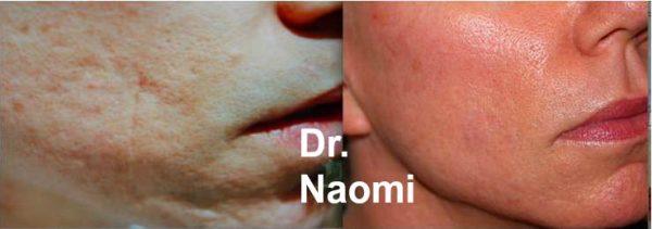 Before and after multiple treatments of treatments for scarring and volume, and fractional laser